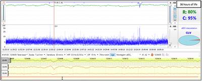 Simultaneous Near-Infrared Spectroscopy (NIRS) and Amplitude-Integrated Electroencephalography (aEEG): Dual Use of Brain Monitoring Techniques Improves Our Understanding of Physiology